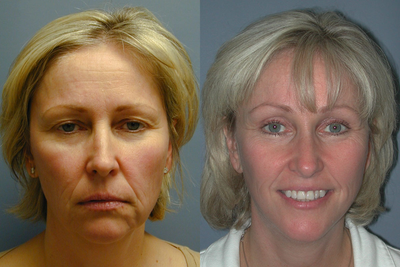 Chin Surgery/Augmentation on 46-year-old - 
	This 46-year-old woman had a Chin Augmentation
