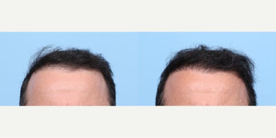 35-44 year old man treated with FUE Hair Transplant, Hair Transplant, Hair Loss Treatment, PRP for Hair Loss, PRP Injections - This 43-year-old patient came to Dr. Wise with thinning in the front and temples. He had an FUT hair transplant in the past with another doctor, and this time chose FUE with Dr. Wise, along with a PRP session during the procedure. The results are a fuller, more natural-looking hairline and improved density in the areas that needed it most.