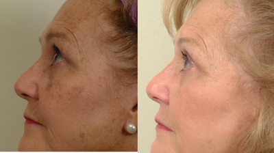 Pearl Laser Treatment - Pearl laser-one treatment