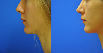 rhinoplasty - for appearance and breathing - She desired a straighter nose and less of a dorsal hump.