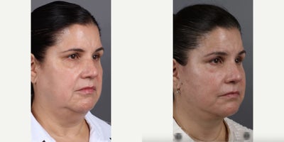 Woman treated with Deep Plane Facelift, Neck Lift, Eyelid Surgery, Facial Fat Transfer - Woman treated with Deep Plane Facelift, Neck Lift, Eyelid Surgery, Facial Fat Transfer