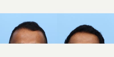 35-44 year old man treated with FUE Hair Transplant, Hair Transplant, Hair Loss Treatment, PRP for Hair Loss, PRP Injections - This patient had an FUE with another physician in the past and was pleased with results but still had scarcity in his crown and hairline. Dr. Wise performed an FUE hair transplant and PRP to achieve these results. He will continue to see growth up to one year.