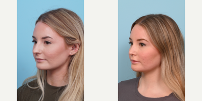 18-24 year old woman treated with Rhinoplasty - This patient says she has difficulty breathing due to a deviated septum. The doctor preformed an external primary rhinoplasty with septoplasty 1 month ago. Her swelling will continue to subside over the next year.