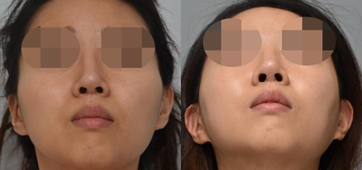 Woman treated with Cheekbone Reduction - Woman treated with Cheekbone Reduction