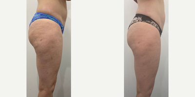 Woman treated with Emtone - Woman treated with Emtone for cellulites