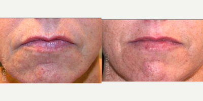 45-54 year old woman treated with ThermiSmooth - ThermiSmooth&trade; is a procedure for improving the appearance of aging skin through skin tightening via increased collagen production. It uses a unique hand piece, called a thermistor. The thermistor delivers targeted heating using temperature controlled RF energy to the surface of the skin. You can get ThermiSmooth as anti-aging solution on your forehead, eyes, cheeks, neck, and even mouth.