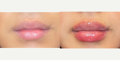 25-34 year old woman treated with Revanesse - This beauty wanted to add a little volume and hydration to her lips. Just a small amount of Versa by Revanesse was used to accomplish this.