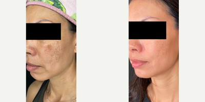 35-44 year old woman treated with Clear and Brilliant, Neo Laser, IPL - This patient had amazing results with the following treatments:- RX Clear and Brilliant, 4 sessions- NeoAerolase Melasma, 4 sessions