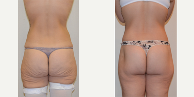 25-34 year old woman treated with Butt Lift, outer thigh lift - This women had undergone significant weight loss. She developed loose skin and drooping of the buttock and posterior thighs. These problems were treated with a full buttock lift, including lifting and tightening of the outer thigh region. The scar is hidden beneath her underwear band.