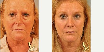 55-64 year old woman treated with Phenol Peel - HETTER PEEL SKIN RESURFACING, Baker-Gordon Phenol Peel by Burke Robinson MD. FACS