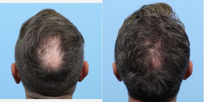 45-54 year old man treated with FUE Hair Transplant, Hair Transplant, Hair Loss Treatment, PRP for Hair Loss, PRP Injections, Aq - This 45-year-old patient had recession on his forehead, specifically around his widows peak, and hair loss in his crown area. Dr. Wise performed an FUE transplant to fortify the front and add density to his crown area. During the procedure, the patient also had PRP injections to the his scalp to fortify the hair follicles and expedite healing.