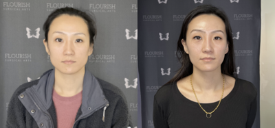 25-34 year old woman treated with Botox for TMJ, Jaw Reduction - Before and after are 12 months apart, with 3 treatments.