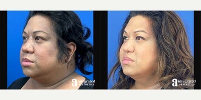 35-44 year old woman treated with AccuTite, Thread Lift, Facial Fat Transfer, Rhinoplasty, Buccal Fat Removal - The patient is a 42-year-old transgender female who has concerns with the appearance of her lower, face, neck, and nose. Dr. Cho performed Accutite and MyEllevate to the lower face and neck, fat grafting to the face, Alar Width and Internal Nare Reduction to the nostrils, and buccal fat removal. The after results are 4 months post-procedure.