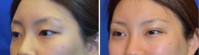 25-34 year old woman treated with Asian Eyelid Surgery - Asian Eyelid Surgery