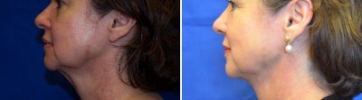 45-54 year old woman treated with Neck Lift - Laser Neck Lift