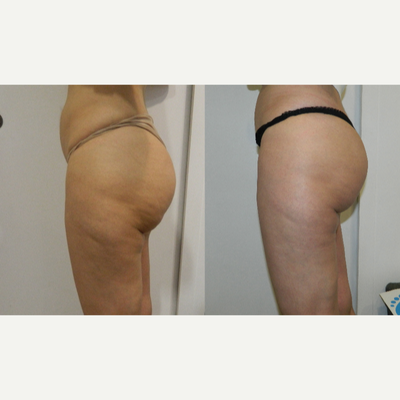35-44 year old woman treated with Carboxytherapy - 40 year old woman treated with 12 sessions of carboxytherapy
