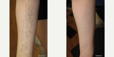 25-34 year old woman treated with PicoSure - Resistant remnants of a tattoo were treated more than seven times with the Medlite laser and the Picosure laser cleared the remnants in three sessions.
