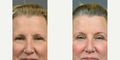 Woman treated with Deep Plane Facelift, Eyelid Surgery - Woman treated with Deep Plane Facelift, Eyelid Surgery