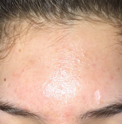 What are the small bumps on my forehead? And what can I do to clear ...