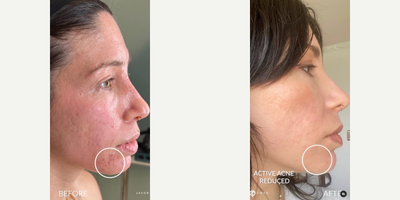 Woman treated with Bellafill, Subcision, CO2 Laser, PlasmaPen - Woman treated with Bellafill, Subcision, CO2 Laser, PlasmaPen