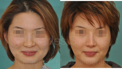 Asian rhinoplasty and genioplasty - 	Asian rhinoplasty and genioplasty