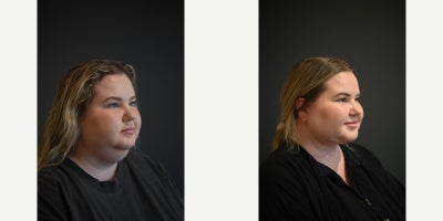 25-34 year old woman treated with Neck Lift - 25-34 year old woman treated with Neck Lift