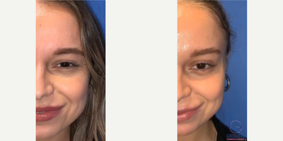 Woman treated with Dysport - Woman treated with Dysport to combat premature lines around her eyes for a natural and smoother look