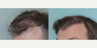 Man treated with Hair Transplant, FUE Hair Transplant - Before and after 1900 FUE grafts to restore hairline and frontal area.