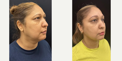 45-54 year old woman treated with FaceTite - Chin and neck liposculpting, facetite