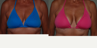 65-74 year old woman treated with Breast Augmentation & Tummy Tuck - 71 year old female 3 months post op treated with Tummy tuck as well as Breast Augmentation with Mentor Silicone Implants 350cc Right and 325 Left.