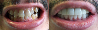 Snap-on Smile - Before and after pictures of a smile makeover procedure
