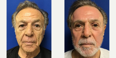 65-74 year old man treated with Facelift - Patient had a Quicklift with Fat Transfer and Laser Resurfacing