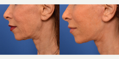 Facelift Revision (age 58) - Had previous facelift and necklift 8 years prior, with recurrence of neck and lower face laxity.