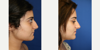 Rhinoplasty (side view R) - Rhinoplasty