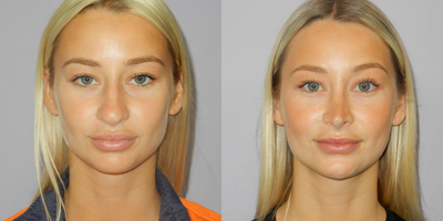 18-24 year old woman treated with Rhinoplasty, Septoplasty - 24 yo woman requesting cosmetic septorhinoplasty.