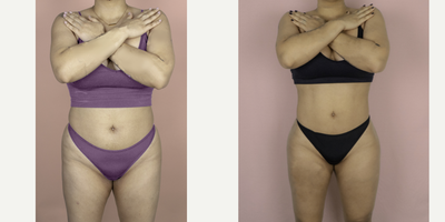 18-24 year old woman treated with Brazilian Butt Lift Revision - This patient had two prior BBL procedures by another surgeon and was unhappy with her results. She is shown here 6 months after surgery with me and is very happy with her improved volume, projection and natural result.