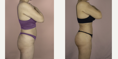 18-24 year old woman treated with Brazilian Butt Lift Revision - This patient had two prior BBL procedures by another surgeon and was unhappy with her results. She is shown here 6 months after surgery with me and is very happy with her improved volume, projection and natural result.