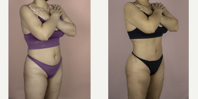 18-24 year old woman treated with Brazilian Butt Lift Revision - This patient had two prior BBL procedures by another surgeon and was unhappy with her results. She is shown here 6 months after surgery with me and is very happy with her improved volume, projection and natural result.