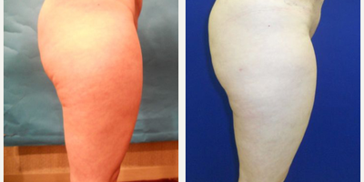 Woman treated with Cellulaze - Woman treated with Cellulaze