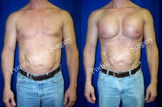 Chest Wall Reconstruction, Pec Implants - This 52-year-old patient has been interested in pectoral implants for a while. This patient is very fit and no matter how much he exercised, he was unable to developed high projecting pectoral muscles. He is almost 2 months post-op bilateral pectoral implant chest augmentation.
