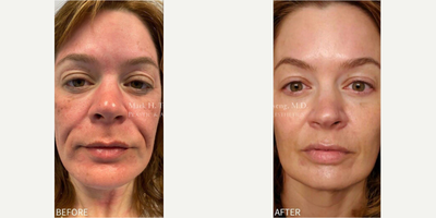 Woman treated with NovaThreads, Nonsurgical Facelift - Woman treated with NovaThreads, Nonsurgical Facelift