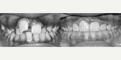 17 or under year old man treated with Braces - A severe anterior dental protrusion caused by thumb sucking was successfully treated with braces.