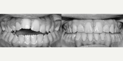 17 or under year old woman treated with Braces - A severe anterior dental open bite caused by thumb sucking was successfully treated with braces.