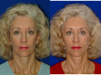 Facial Fat Grafting - 
	Fascial-fat grafts to malar eminences, cheeks, lips, lateral perioral commissures in combination with a rhytidectomy.
