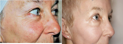 Deep/Active FX Laser Treatment - 
	Sun damage including brown spots, dilated vessels and wrinkles treated with fractionated CO2 laser resurfacing (Total FX) and Botox (around eyes)

