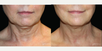 55-64 year old woman treated with Venus Viva - 1 month after 6 treatments of Venus VivaMD