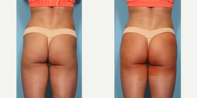 29 year old woman treated with Sculptra Aesthetic for Buttock Augmentation - 29 year old woman treated with Sculptra Aesthetic for Buttock Augmentation. 10 vilas, 150 mL on each side.