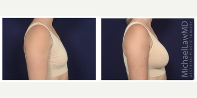 25-34 year old woman treated with Sientra Breast Implants - Breast augmentation. Follow-up photo taken 1 month after the procedure.