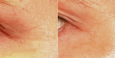 Woman treated with Pelleve - Woman treated with Pelleve