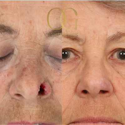 65-74 year old woman treated with Mohs Surgery, Facial Reconstructive Surgery - Patient had a Merkel Cell Carcinoma on her left nostril. After resection this left her with a full thickness defect. We used a 3 stage Paramedian Forehead Flap to with auricular cartilage to reconstruct the the nose and provide a natural contour.